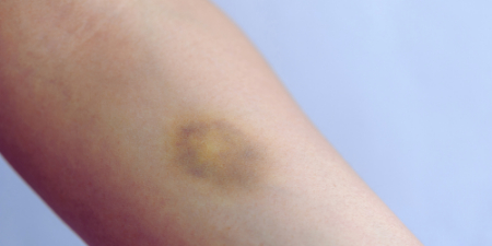 علائم بیماری کلیوی, تورم در پاها