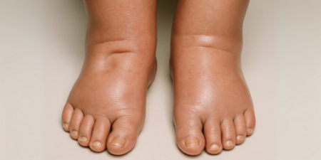 علائم بیماری کلیوی, تورم در پاها