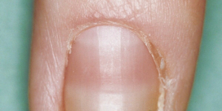 علائم بیماری کلیوی, تورم در پاها