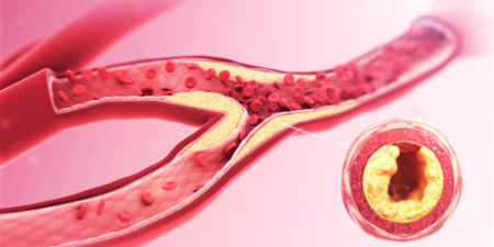 علائم بیماری کلیوی, تورم در پاها