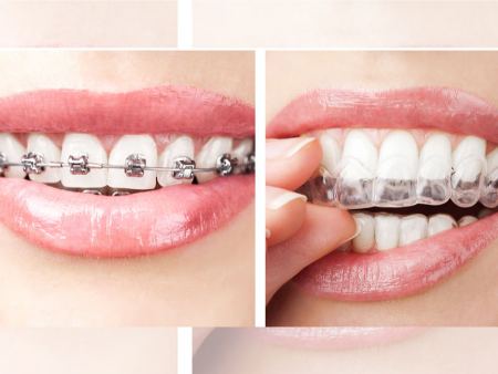 انواع روش‌ های ارتودنسی دندان