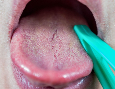 زبان شیاردار, بهداشت زبان شیاردار