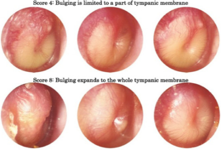 پیشگیری از عفونت گوش کودکان
