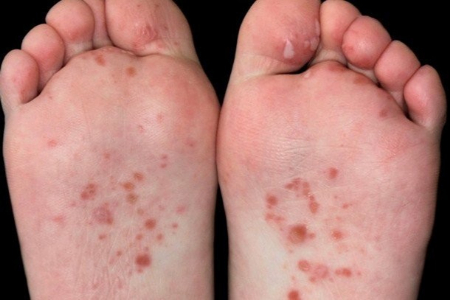 لکه‌های قرمز کف پا, بثورات پوستی پا