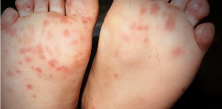 لکه‌های قرمز کف پا, بثورات پوستی پا