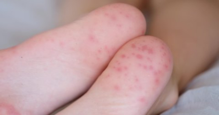 لکه‌های قرمز کف پا, بثورات پوستی پا