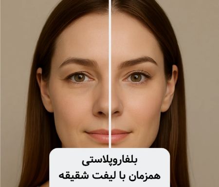 ترکیب جراحی لیفت شقیقه و بلفاروپلاستی