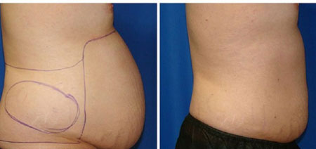 لیپوساکشن اولتراسونیک, لیپوساکشن ویزر,اولتراسونیک چیست