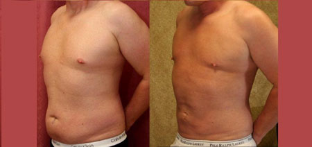 لیپوساکشن اولتراسونیک, لیپوساکشن ویزر,اولتراسونیک چیست