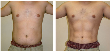 لیپوساکشن اولتراسونیک, لیپوساکشن ویزر,اولتراسونیک چیست