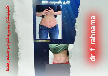 نتیجه لاغری در کلینیک دکتر فرخنده رهنما