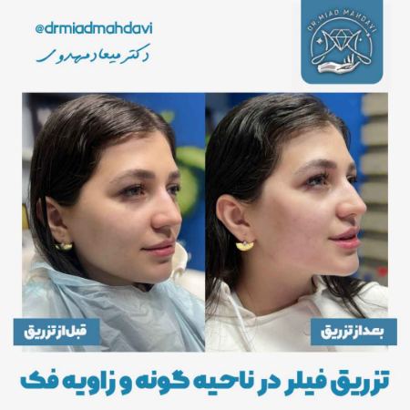 کانتورینگ صورت دکتر میعاد مهدوی