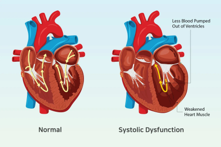 نارسایی قلبی, پیشگیری از نارسایی قلبی