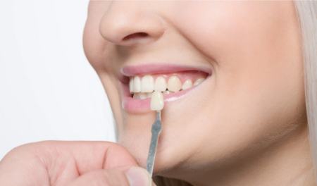 کامپوزیت دندان