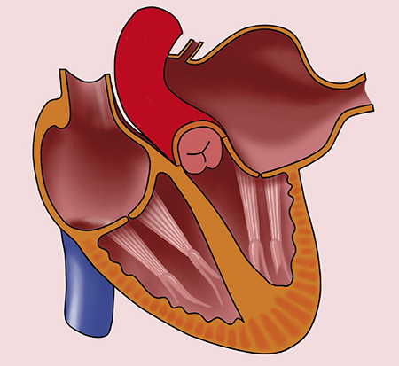 بزرگ شدن دهلیز چپ, علت بزرگ شدن دهلیز چپ