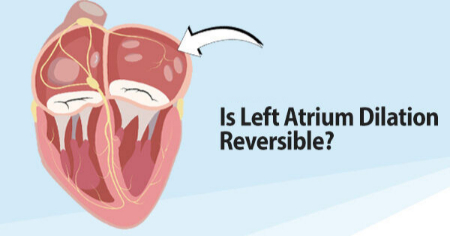 بزرگ شدن دهلیز چپ, علت بزرگ شدن دهلیز چپ