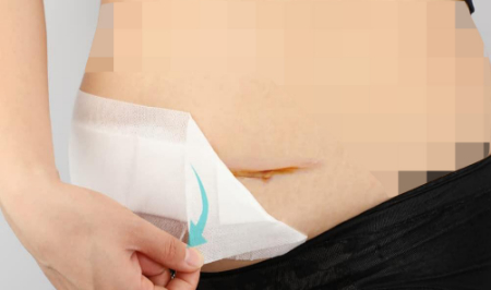 جدا کردن گاز استریل از زخم, استفاده از سرم برای جدا کردن گاز استریل