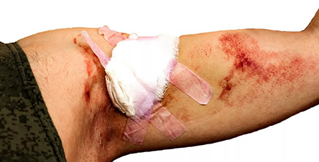 جدا کردن گاز استریل از زخم, استفاده از سرم برای جدا کردن گاز استریل