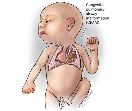 ناهنجاری مادرزادی ریه, ناهنجاری مادرزادی ریه در بزرگسالان