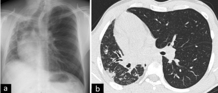 ناهنجاری مادرزادی ریه, ناهنجاری مادرزادی ریه در بزرگسالان