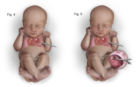 ناهنجاری مادرزادی ریه, ناهنجاری مادرزادی ریه در بزرگسالان