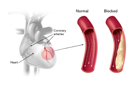 باز کردن رگ قلب, درمان طبیعی تصلب شرایین