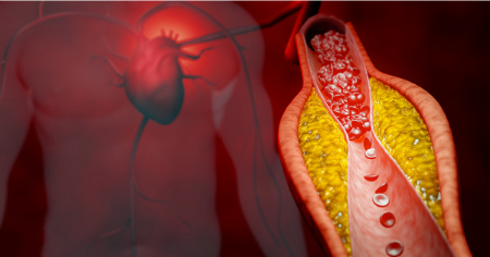 باز کردن رگ قلب, درمان طبیعی تصلب شرایین
