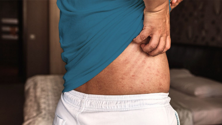 خارش شکم, خارش پوست بدن و شکم