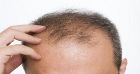 مقایسه هزینه و قیمت کاشت مو به روش SUT با FUE